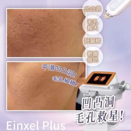 Einxel Plus 微針儀器